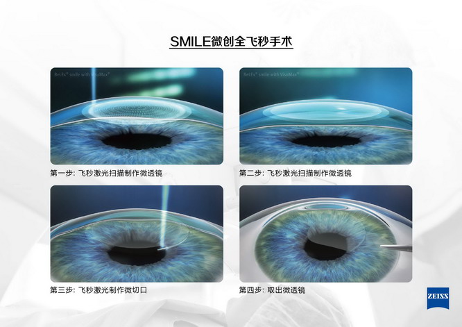 高考后在重庆做近视手术,如何选择手术方式?重庆近视手术专家汪红来揭秘! 高考后在重庆做近视手术,如何选择手术方式?重庆近视手术专家汪红来揭秘!